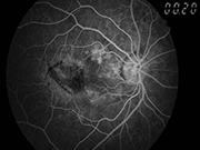 Indocyanine green angiography