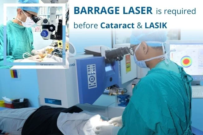 Barrage Laser Before Lasik And Cataract Surgery