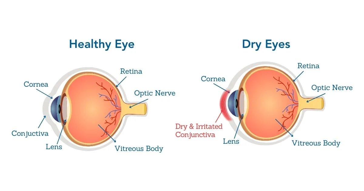 Dry Eyes Treatment Delhi