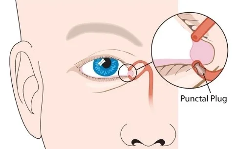 Punctal Plugs For Dry Eyes