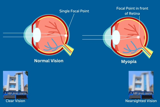 What is myopia