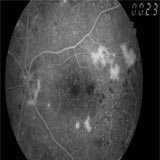 advanced retinopathy