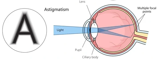 Astigmatism Refractive Error