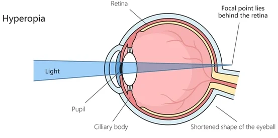 Hyperopia Refractive Error