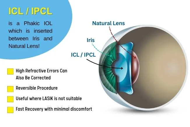 Icl And Ipcl Surgery