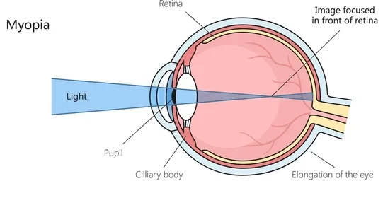 Myopia Refractive Error