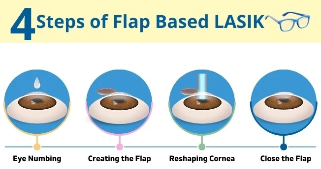 Steps For Flap Based Lasik