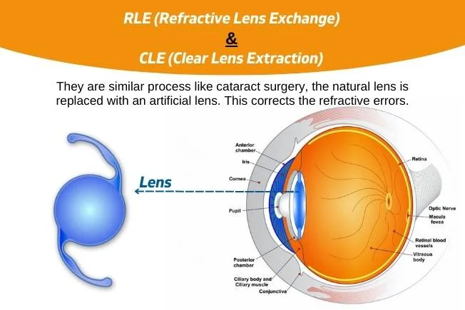 Rle And Cle Refractive Surgery