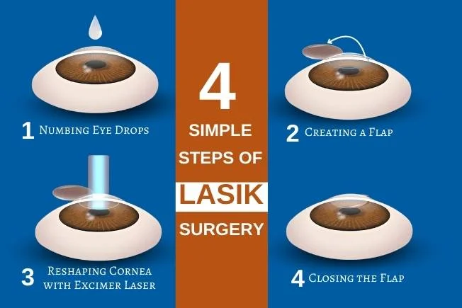 Steps Of Lasik Surgery