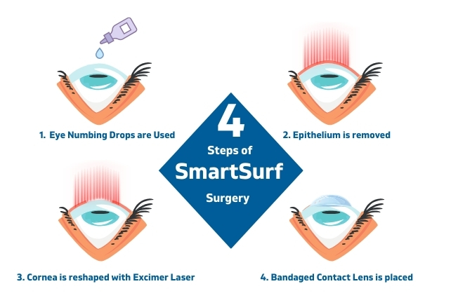 Steps of SmartSurf LASIK