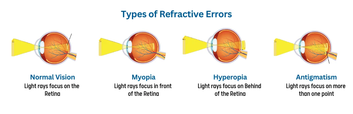  types of Refractive Errors