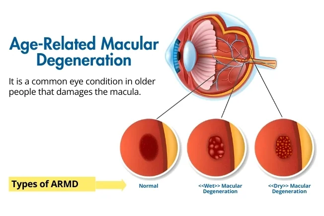 Age-Related Macular Degeneration