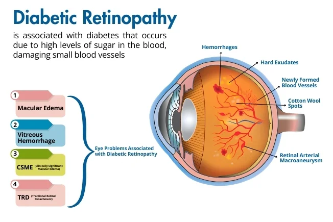 Diabetic Retinopathy Treatment