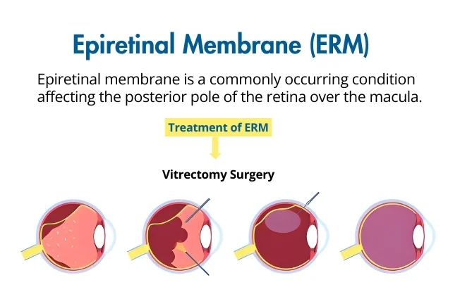 Epiretinal Membrane (ERM) Treatment