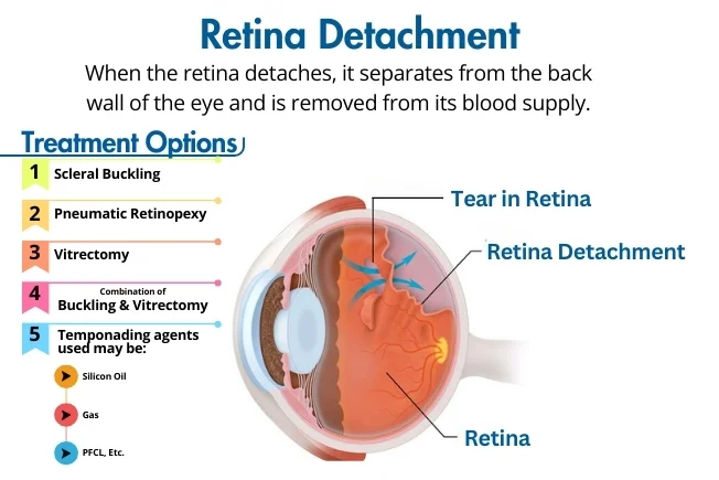 Retinal Detachment