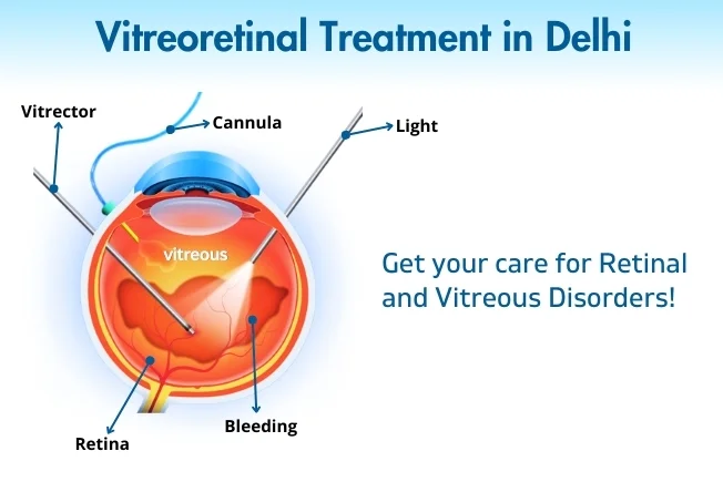 Vitreoretinal Treatment In Delhi