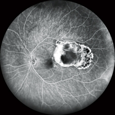 FFA and ICG Eye Test