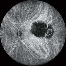 FFA and ICG Eye Test