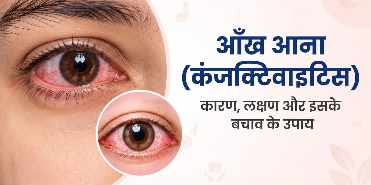 आंख आना (कंजक्टिवाइटिस) में आंख की लालिमा और सूजन का चित्रण
