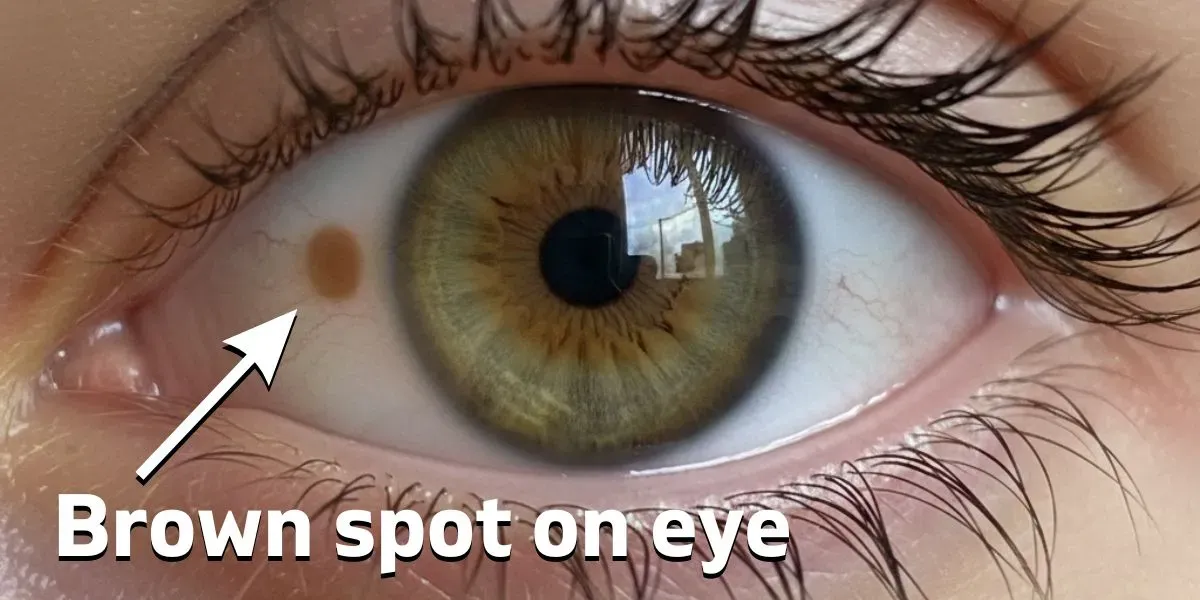 Close-up of a brown pigmented spot (eye freckle) on the white part of an eye