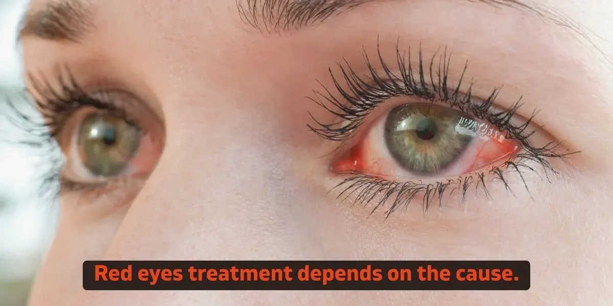 Close-up of a red, bloodshot eye