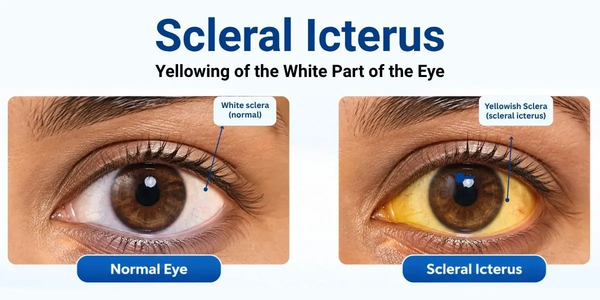 Close-up of an eye showing scleral icterus, yellow discoloration of the white of the eye