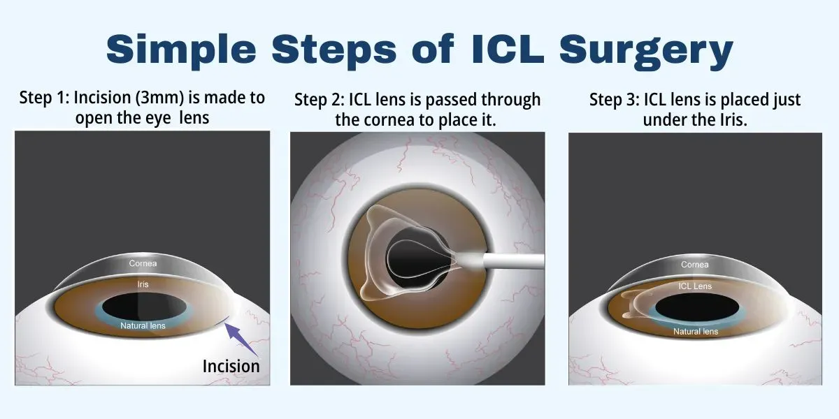 ICL eye surgery in Delhi