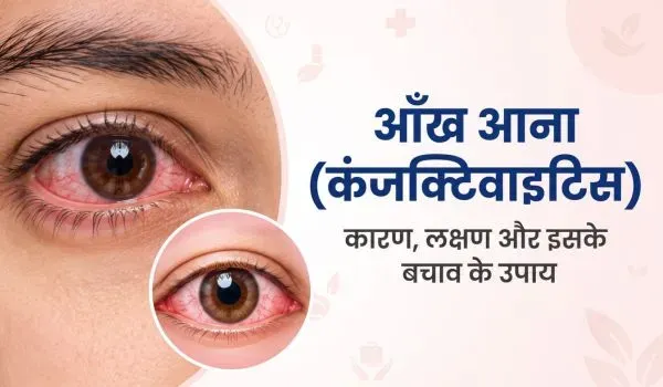 आंख आना (कंजक्टिवाइटिस) क्या है? कारण, लक्षण और इलाज