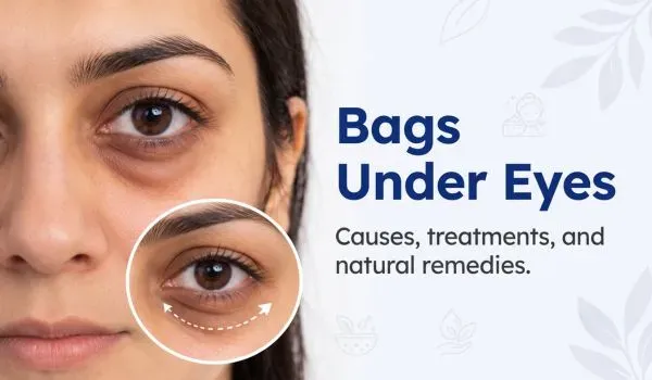 Bags Under Eyes: Causes, Symptoms, Treatment & Prevention Tips
