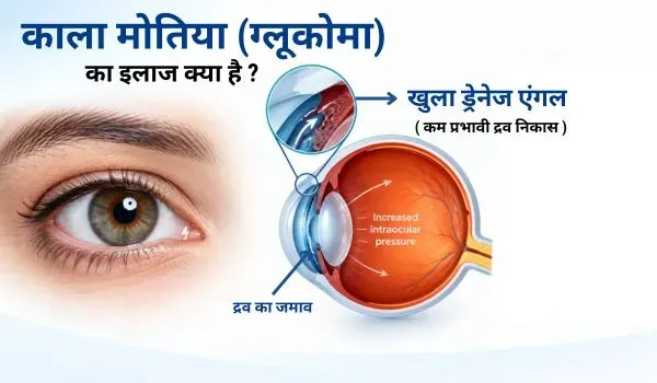 काला मोतिया (ग्लूकोमा) का इलाज: कारण, लक्षण और बचाव