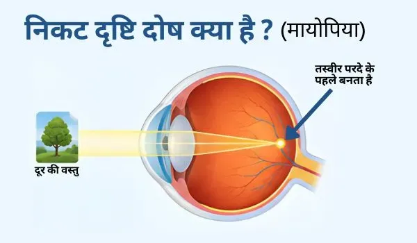 निकट दृष्टि दोष (मायोपिया) क्या है? कारण, लक्षण और इलाज