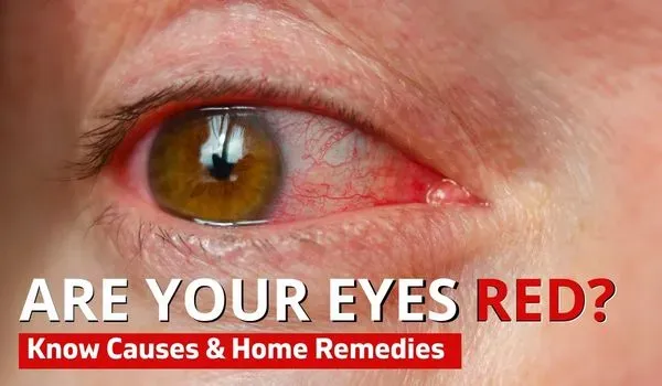 Red Eyes Treatment: Causes, Home Remedies & When to See a Doctor