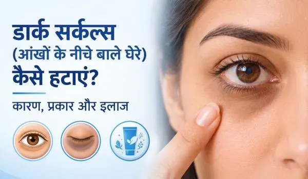 डार्क सर्कल्स (आंखों के नीचे काले घेरे) कैसे हटाएं? कारण, प्रकार और इलाज
