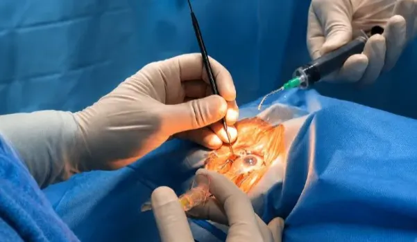 Cataract Surgery