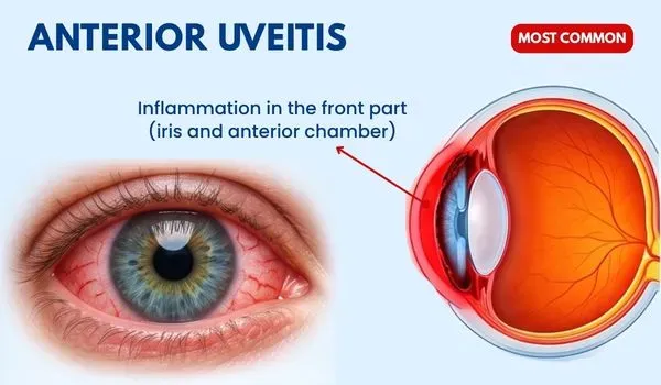 Anterior Uveitis (Iritis)