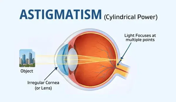 Astigmatism