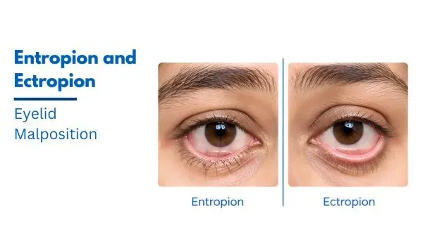 Entropion and Ectropion