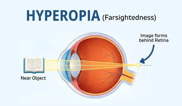 Hyperopia (Farsightedness)