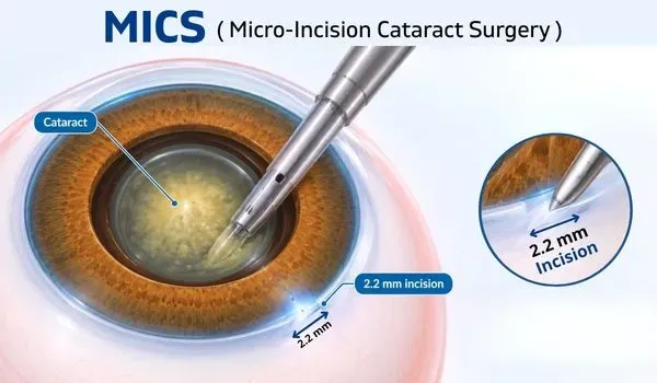 MICS (Micro-Incision Surgery)